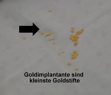 Goldimplantate